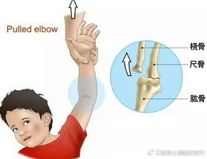 手腕脱臼吃什么补品，手腕脱臼康复