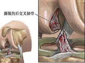 韧带断裂吃什么钙片好，韧带断裂有什么维生素可以吃吗